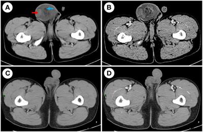 A case report of primary para-testicular spindle cell rhabdomyosarcoma